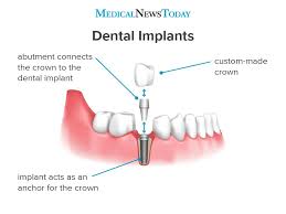 False teeth aren't just for people who've lost their teeth. What Are Dental Implants Types Procedures And More