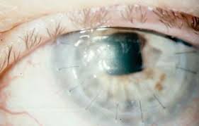 Restasis is an immunosuppressive medication that works to reduce inflammation in the tear glands, helping to prevent further damage. The Latest Uses Of Restasis