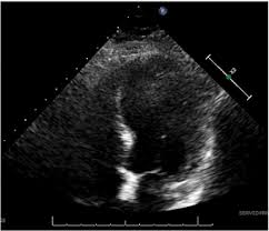 Sep 02, 2016 · stress tests can detect when arteries have 70% or more blockage. Traumatic Takotsubo Cardiomyopathy In A Patient With Extensive Coronary Artery Disease