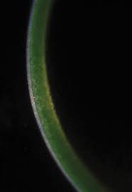 Clearing Up Corneal Haze | Corneal Physician