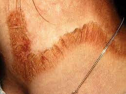 Symptoms include inflamed skin, diarrhea, dementia, and sores in the mouth. Pellagra Definition Symptoms Pictures And More