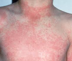 Ciao ragazzi, mi è capitato di recente di sentire parlare di ppd…in particolare un rappresentante di una nota azienda me l'ha menata con un colore no ammonia e in realtà, essendo totalmente ignorante in materia ho cercato qualcosa per capire vantaggi e/o svantaggi di un colore senza ppd….ecco cosa. Waschmittelallergie Symptome Ursachen Und Waschmittel Fur Allergiker