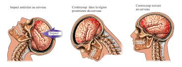 Les employés de bureau, en plus de subir de l'anxiété en permanence, sont également en mauvaise posture en raison de leur période assise prolongée. Coup Du Lapin Traitements Symptomes Et Causes Gare Aux Lendemains