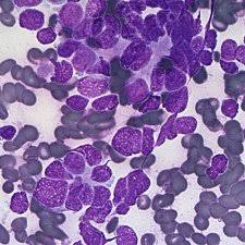 Clinical characteristics of merkel cell carcinoma at diagnosis in 195 patients: Pdf Fine Needle Aspiration Cytology Of Merkel Cell Carcinoma A Review Of 69 Cases