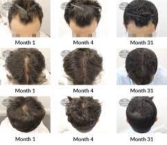 It can be the result of heredity, hormonal changes, medical conditions or a normal part of. Hair Growth Success Story Delighted With The Results And Service Received