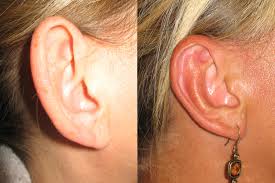 Ear Reduction Otoplasty Big Ear Surgery Protruding Ears Macrotia Ear  Reduction Surgery Cost Otoplasty