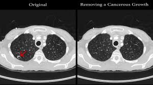 Malware Can Be Used To Add Fake Cancer Tumors To Or Remove Tumors From Ct Scan And Mri Images Gigazine