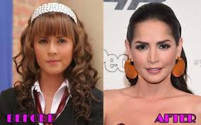 Pero el antes y el después carmen villalobos seguro te sorprenderá. Plasticsurgeryphoto Co Nose Jobs Before And After Cosmetic Surgery Nose Job