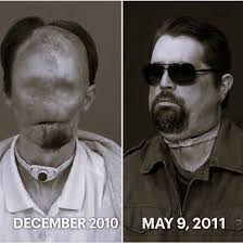 In 2008, Dallas Wiens, an American construction worker, suffered a  devastating electric shock while working near high-voltage wires. The  accident left his face severely burned and melted, and he lost his sight