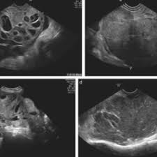 Ovarian cancer risk factors & prevention. Primary Ovarian Cancer Iota