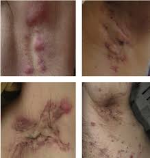Hidradenitis Suppurativa An Overview Sciencedirect Topics