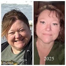 Gastric Bypass Surgery Long-Term Weight Loss Success Story