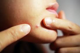 Utiliser des produits doux, sans alcool et sans savon pour la toilette. Trucs Et Astuces Lutter Contre L Acne Et Les Boutons