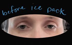 Image result for Ice Pack Test