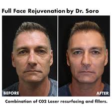 Amazing subtle, natural, yet dramatic full face “MANtenance” by Dr. Luis  Soro. This Olympic team captain, represented the United States diving team  at both the 1996 Olympics in Atlanta and the 2000