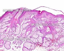 Image result for Sebaceous Gland