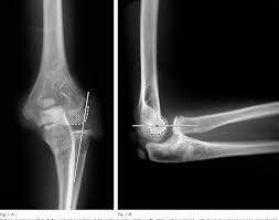 Image result for Radial Head Dislocation