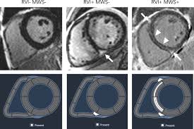 Maybe you would like to learn more about one of these? Right Ventricular Insertion Site Fibrosis In A Dilated Cardiomyopathy Referral Population Phenotypic Associations And Value For The Prediction Of Heart Failure Admission Or Death Journal Of Cardiovascular Magnetic Resonance Full Text