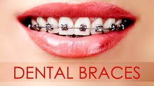 Insmagro global solutions private limited insmagro global solutions private limited computer software chennai, tamil nadu show more similar pages. Different Types Of Dental Braces For Your Teeth Youtube