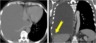 Almost always involve parietal … Asbestos Related Lung Disease A Pictorial Review Sciencedirect