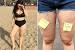 Cellulite Before And After Diet And Exercise