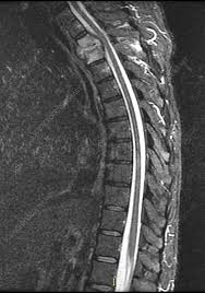Image result for Spinal Infection