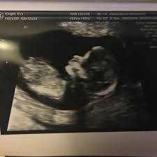 12 Weeks Ultrasound 12 Week Ultrasound Ultrasound 12 Weeks