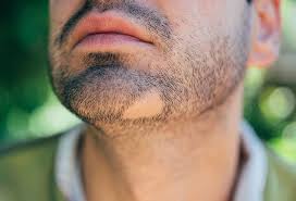 These patches may connect, however, and then become noticeable. What Are The Main Causes Of Alopecia Areata