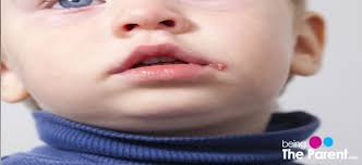 A newborn baby has no immunity to this disease at all and so he must be kept protected from children who have any kind of. Cold Sores In Babies Symptoms Causes Treatment And Prevention Being The Parent