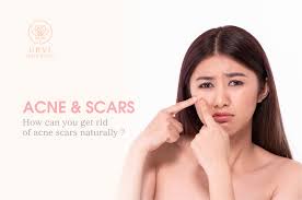 How To Get Rid Of Acne Scars Naturally Urvi Naturals