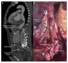 Each kidney is approximately three vertebrae in length. Ruptured Abdominal Aortic Aneurysm In A Patient With Right Pelvic Kidney And Previous Left Nephrectomy European Journal Of Vascular And Endovascular Surgery