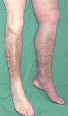 Thrombose