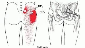 Piriformis Syndrome And Trigger Points C1 Chiropractic Health Centre