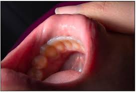 Image result for Gingivitis