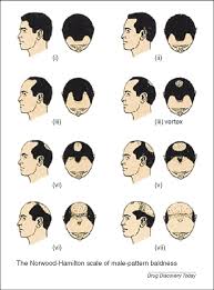 The most common cause of hair loss is a hereditary condition that happens with aging. Hamilton Norwood Male Pattern Baldness Scale Reproduced From Norwood Download Scientific Diagram