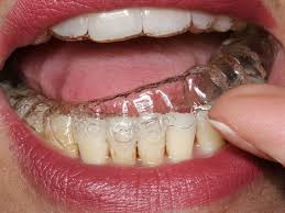 A Partir D Un Certain Age Difficile D Envisager Porter Un Appareil Dentaire Pourtant De Nouvelles Techniques Permettent Auj Dental Images Invisalign Dental