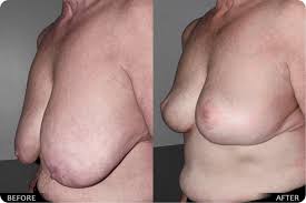 Natural Breast Lift & Teardrop Implants by Dr. Steinbacher in Guilford, CT