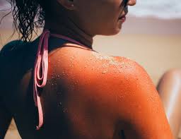 Image result for Sunburn