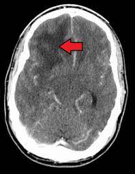 Glioblastoma Wikipedia