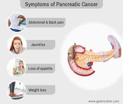 This article listed the early signs of pancreatic cancer in women from reliable sources. Gastro Clinix Early Stage Pancreatic Cancer Rarely Causes Symptoms Symptoms May Not Appear Until The Cancer Is Large Enough To Affect Nearby Organs Or Has Spread People Who Notice Any Of These