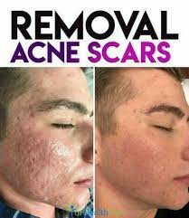 Pin On Best Acne Treatment Tips