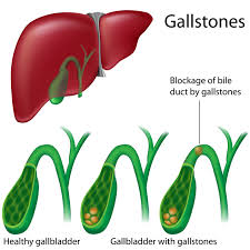 The gall bladder is not connected to the urinary system, so it is impossible to pass a gall stone in urine. What Does A Gallbladder Attack Feel Like University Health News