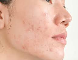 Vente de produits éclaircissant pour les peaux abîmées ou irritées sur citymall.ma. Traiter Votre Acne Avec Un Peeling De La Gamme Pca Skin