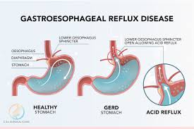 For the past 3 weeks i have had a feeling that something is stuck in the back of my throat. Always Suffering From Heartburn Or Acid Reflux You May Have A Digestive Disorder Health News Top Stories The Straits Times