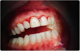 Gums that bleed during brushing or chewing. Bleeding Gums When To Be Concerned