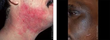 Image result for ekzema face