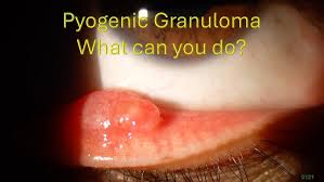 Image result for Pyogenic Granuloma