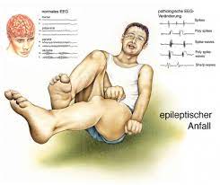 Epilepsie Ursachen Beschwerden Therapie Gesundpedia De