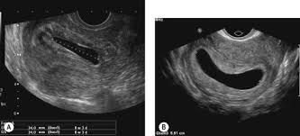 Gestational Sac An Overview Sciencedirect Topics