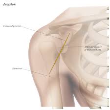 shoulder anterior deltopectoral approach approaches